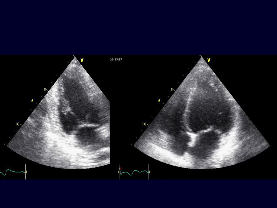 дилатационная кардиомиопатия узи