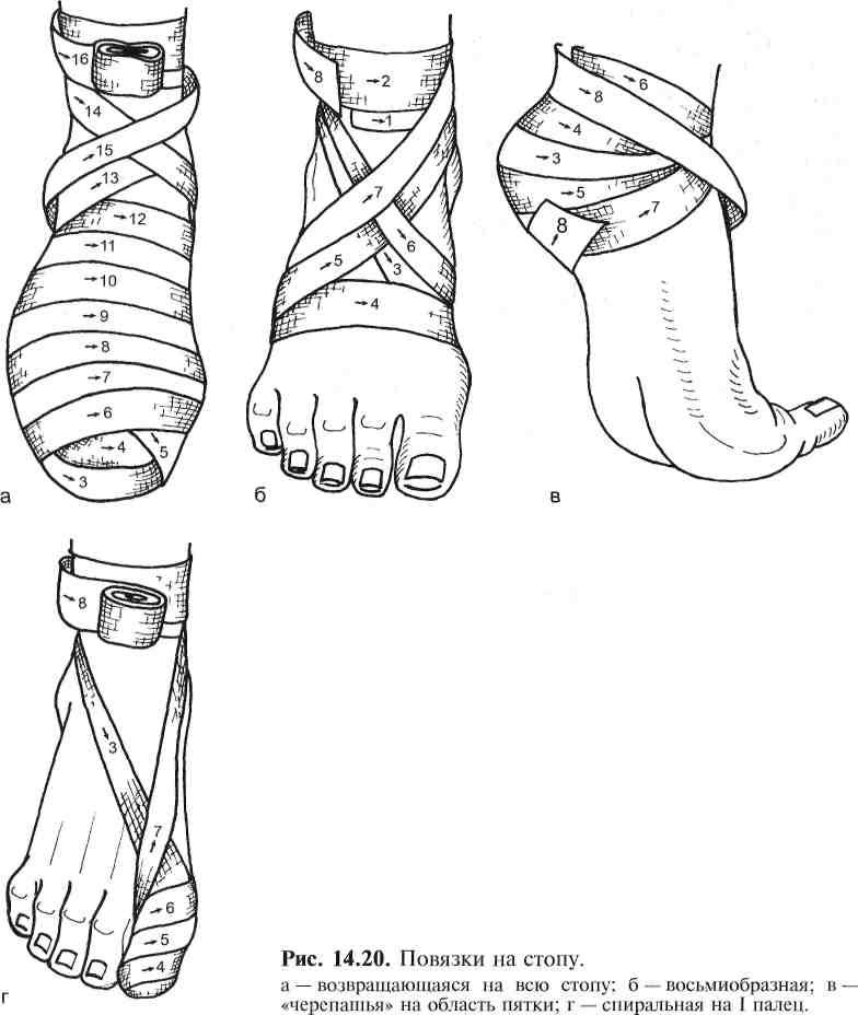 Какая повязка накладывается при повреждении голеностопного сустава. Бинтование ног эластичным бинтом алгоритм. Технику наложения бинтовой повязки на голень. Техника наложения бинтовой повязки на голень. Бинтование голеностопа восьмеркой.