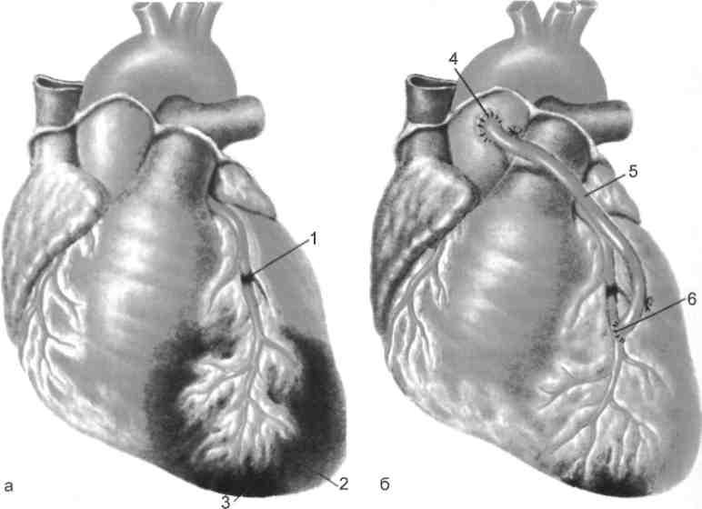 Что такое шунтирование сердца и сосудов. Аорта коронарное шунтирование. Инфаркт шунтирование аортокоронарное шунтирование. Аорта....аортокоронарное...шунтирование. Коронарное шунтирование ПМЖВ.