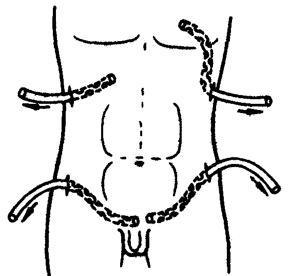Схема дренирования брюшной полости при перитоните