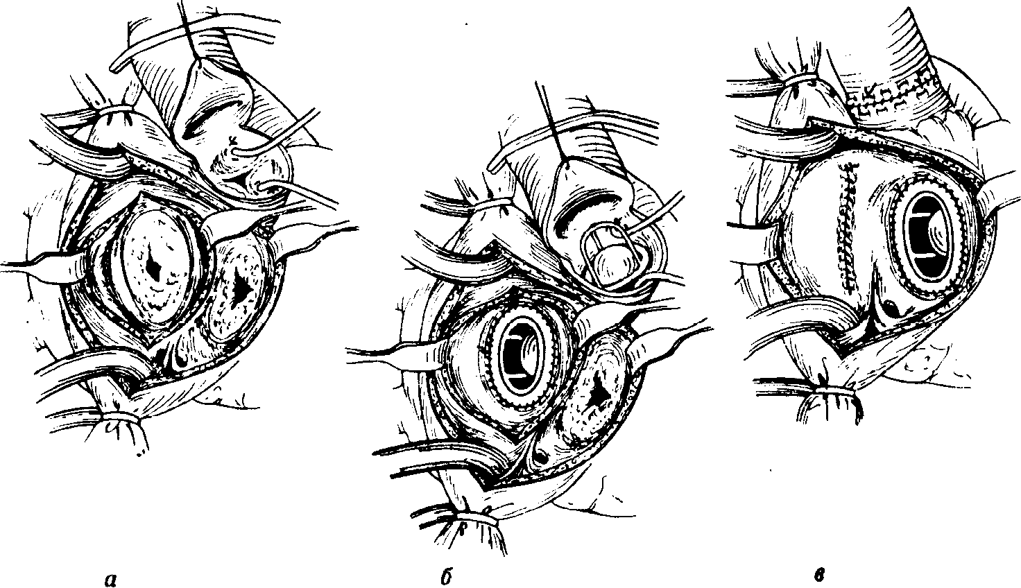 Операция клапана. Комиссуротомия аортального клапана. Чрескожная митральная комиссуротомия. Открытая комиссуротомия митрального клапана. Комиссуротомия при митральном стенозе.