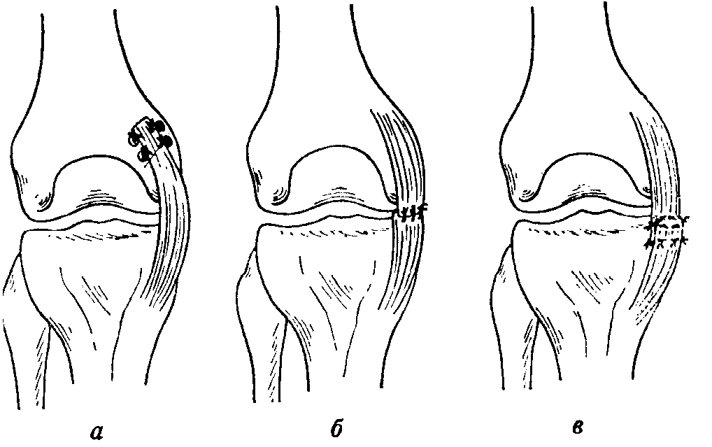 Операция по восстановлению коленного сустава