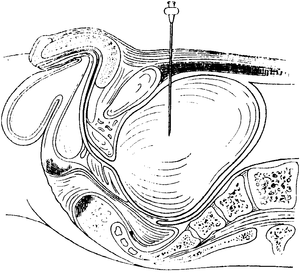 Мочеиспускание после удаления простаты. Пункция мочевого пузыря. Пункция мочевого пузыря, цистостомия. Надлобковая пункция мочевого. Техника надлобковой пункции мочевого пузыря.