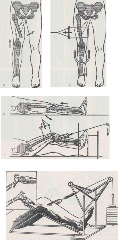 Восстановление перелома бедренной кости. Экстрамедуллярный остеосинтез бедренной кости. Остеосинтез коленного сустава.