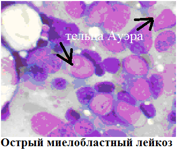 Основные клинические синдромы при лейкозах