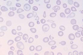 Железодефицитной анемии талассемии некоторых гемоглобинопатиях thumbnail