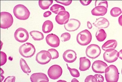 Гемоглобинопатии талассемия и серповидно клеточная анемия