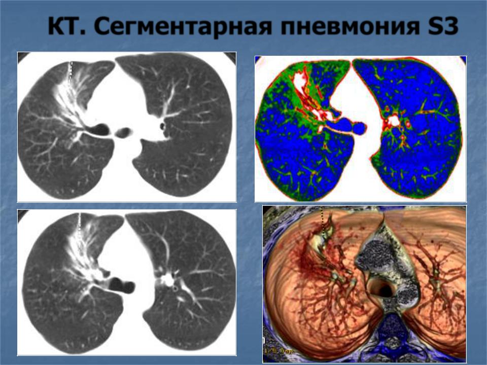 Полисегментарная пневмония Полисегментарная пневмония