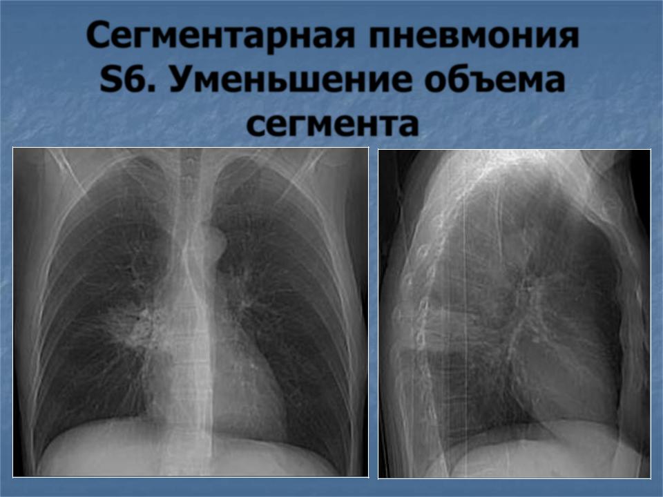 S6 в легких в правом легком. Пневмония правосторонняя s4 s5. Полисегментарная пневмония s1-s2. Сегментарная пневмония кт. Двухсторонняя сегментарная пневмония.