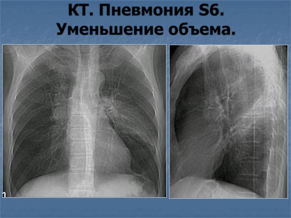 Полисегментарная пневмония Полисегментарная пневмония