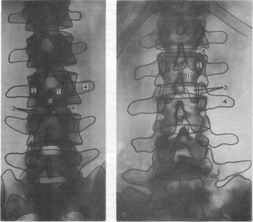 Укладки для рентгенографии грудного и поясничного отдела позвоночника