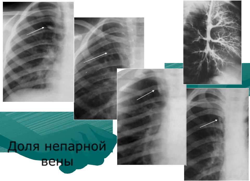 Непарная вена легких. Вена азигос рентген. Добавочная Вена азигос. Вена azygos рентген.