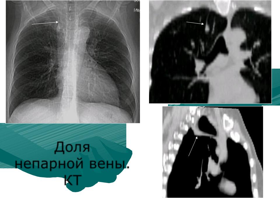 Непарная вена легких. Добавочная Вена азигос рентген.
