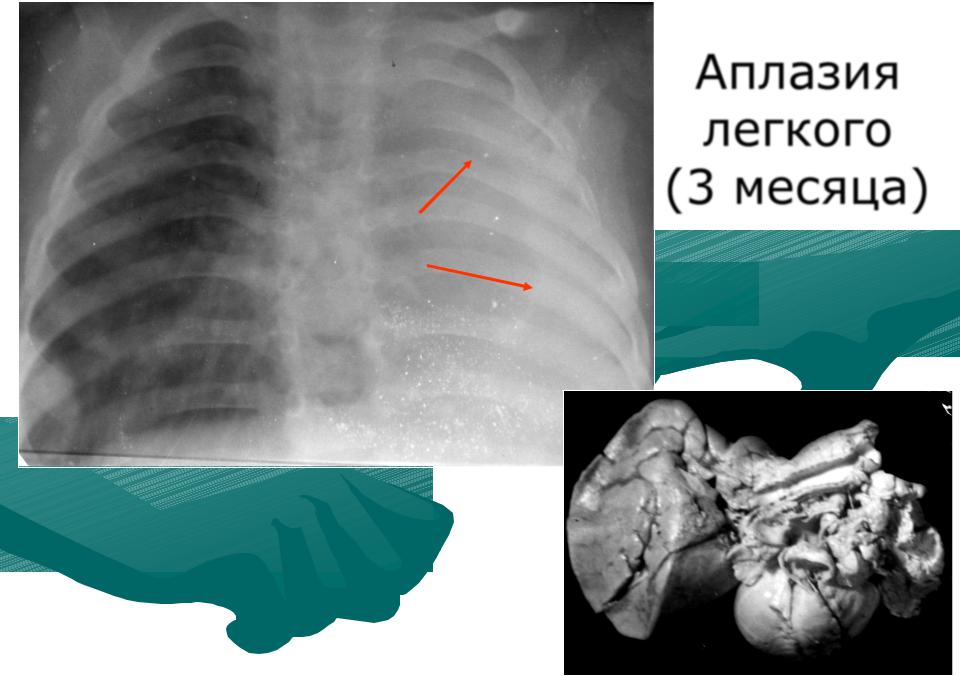 Гипоплазия легкого фото
