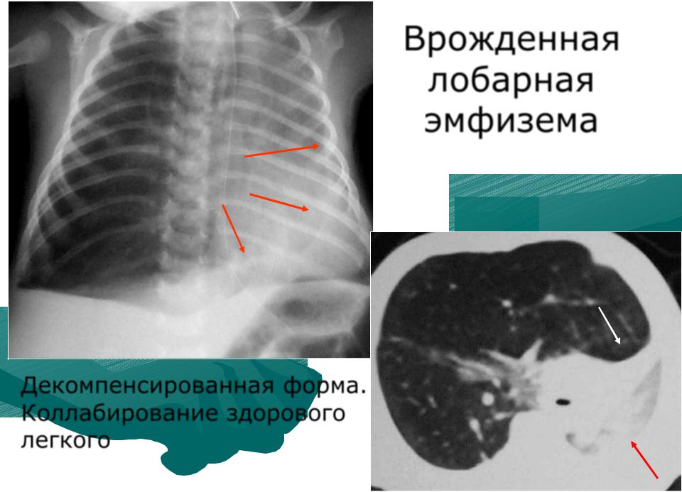 Врожденная лобарная эмфизема