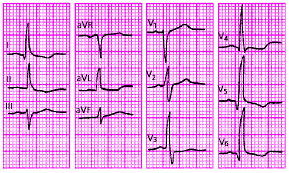 Поворот сердца верхушкой кпереди на ЭКГ. Повороты сердца на ЭКГ вокруг продольной оси. ЭКГ отклонение верхушкой кзади. Поворот сердца верхушкой вперед на ЭКГ. Поворот правым желудочком вперед