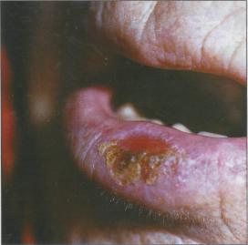 Предраковые заболевания полости рта