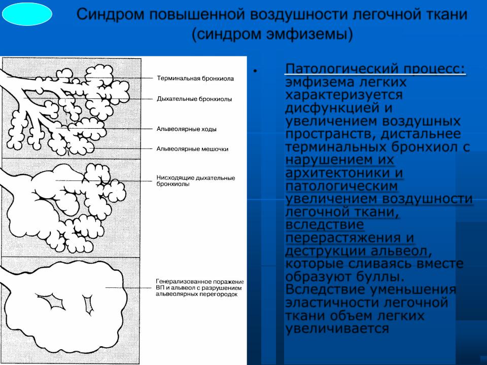 Легкое повышение. Синдром повышения воздушности легочной ткани эмфизема легких. Синдром повышенной воздушности легочной ткани пропедевтика. Синдром повышенной воздушности легочной ткани причины. Синдром повышенной воздушности легочной ткани патогенез.