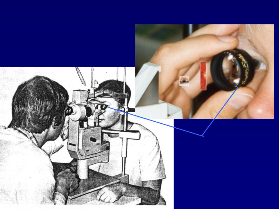 Офтальмоскопия что это. Офтальмоскопия с линзой Гольдмана. Линза Гольдмана обследование. Линза для осмотра глазного дна. Офтальмоскопия с щелевой лампой.