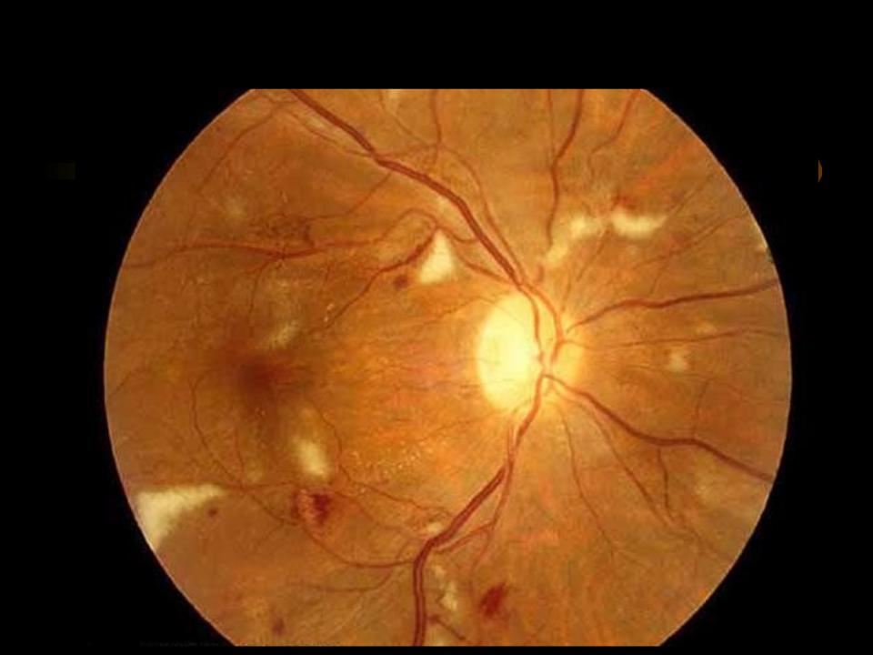 Гипертоническая ангиопатия обоих глаз. Хроническая ишемическая ретинопатия. Мягкие экссудаты сетчатки. Солнечная ретинопатия окт. Серповидноклеточная ретинопатия.