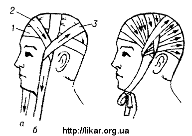 Техника наложения повязки чепец. Повязка чепец техника. Чепец техника наложения. Наложение повязки на голову чепец. Бинтование головы чепец.