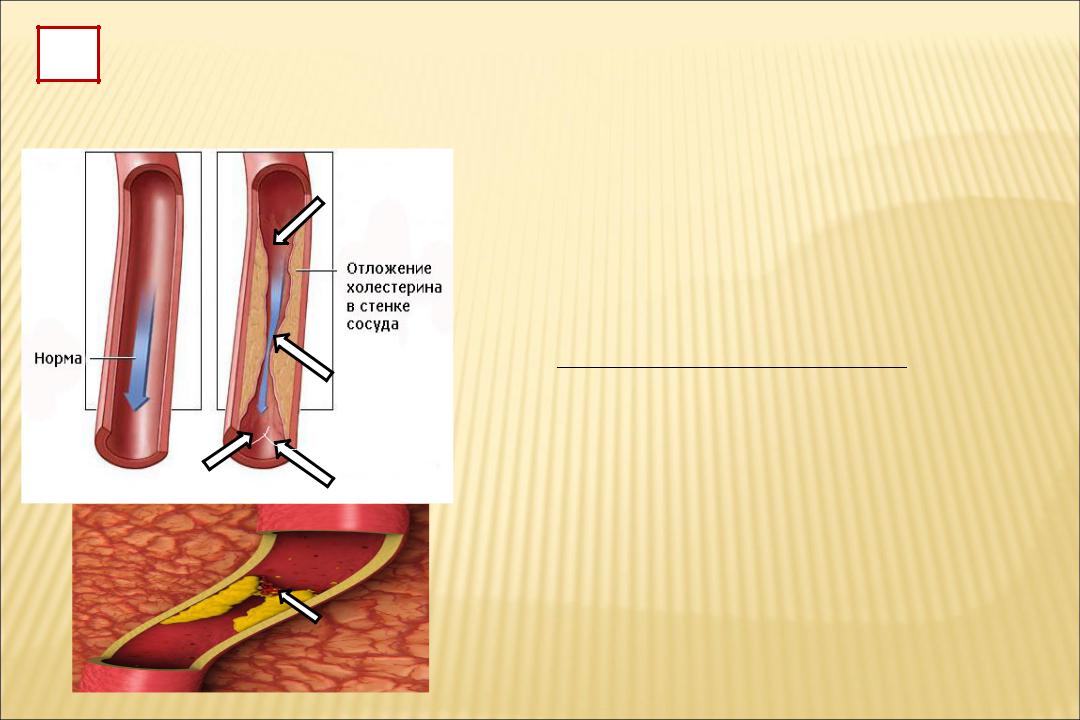 Тромбоз артерий лечение