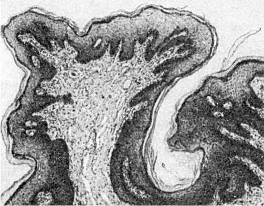 Струков серов патологическая анатомия миома матки описание