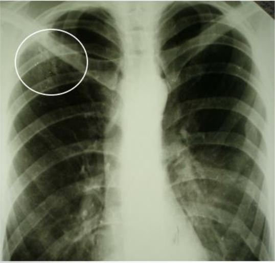 Тени в верхней доле легкого. Очаговый туберкулез рентген. Инфильтративный туберкулез s1 s2. Инфильтративный туберкулез легких s1 s2. Флюорография снимок туберкулез.