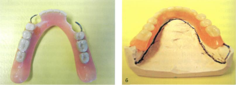 Границы пластиночного протеза. Базис пластиночного протеза. Границы базиса полного съемного протеза на верхней челюсти. Границы базиса частичного съемного пластиночного протеза. Границы съемного пластиночного протеза на нижней челюсти.