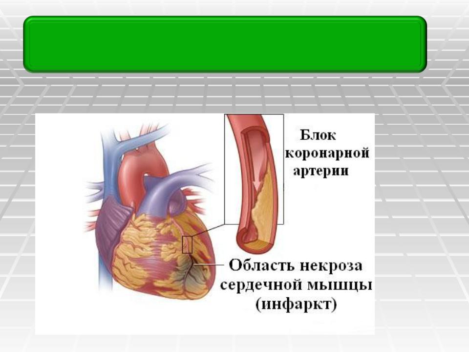 Сердечный тромбоз. Признаки тромбоза сердца. Тромб сердца тромб в сердце. Тромбоз сердца симптомы.