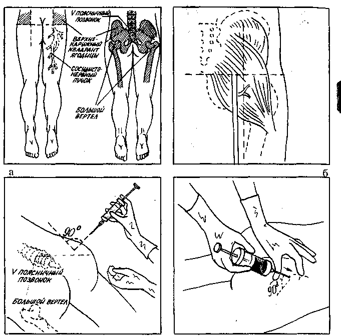 Схема уколов внутримышечно