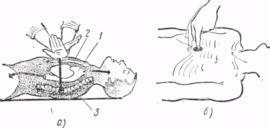 Непрямой массаж сердца глубина продавливания