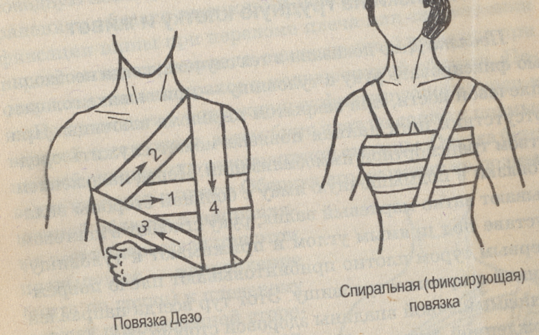 Повязки дезо схема