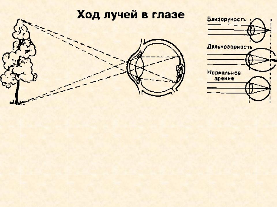 Схема хода лучей при дальнозоркости