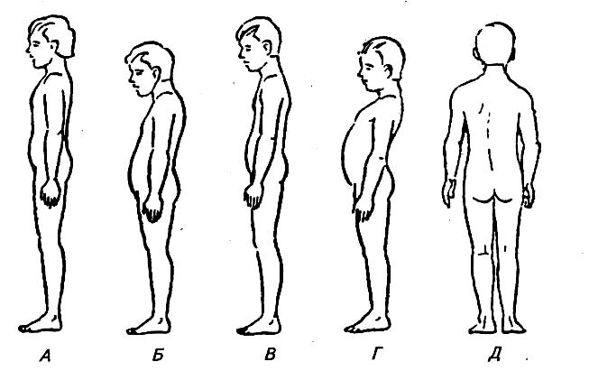 Нарушение осанки и плоскостопие. Нарушение осанки в сагиттальной и фронтальной плоскости. Дефекты осанки в сагиттальной плоскости. Тип осанки кругловогнутая спина. Вторая степень нарушения осанки.