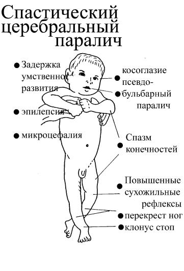 Признаки дцп в месяц. ДЦП В легкой форме симптомы у детей до года. Симптомы ДЦП У грудничка в 2 месяца. ДЦП симптомы у детей 2 лет. Симптомы ДЦП У новорожденных в 6 месяцев.