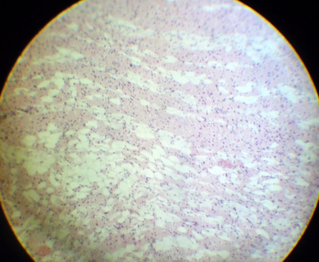 Гемосидероз стенки кисты яичника