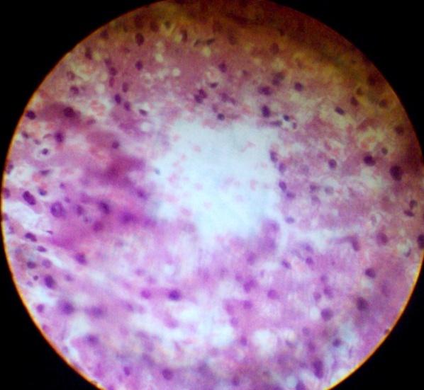 Гемосидероз стенки кисты яичника thumbnail