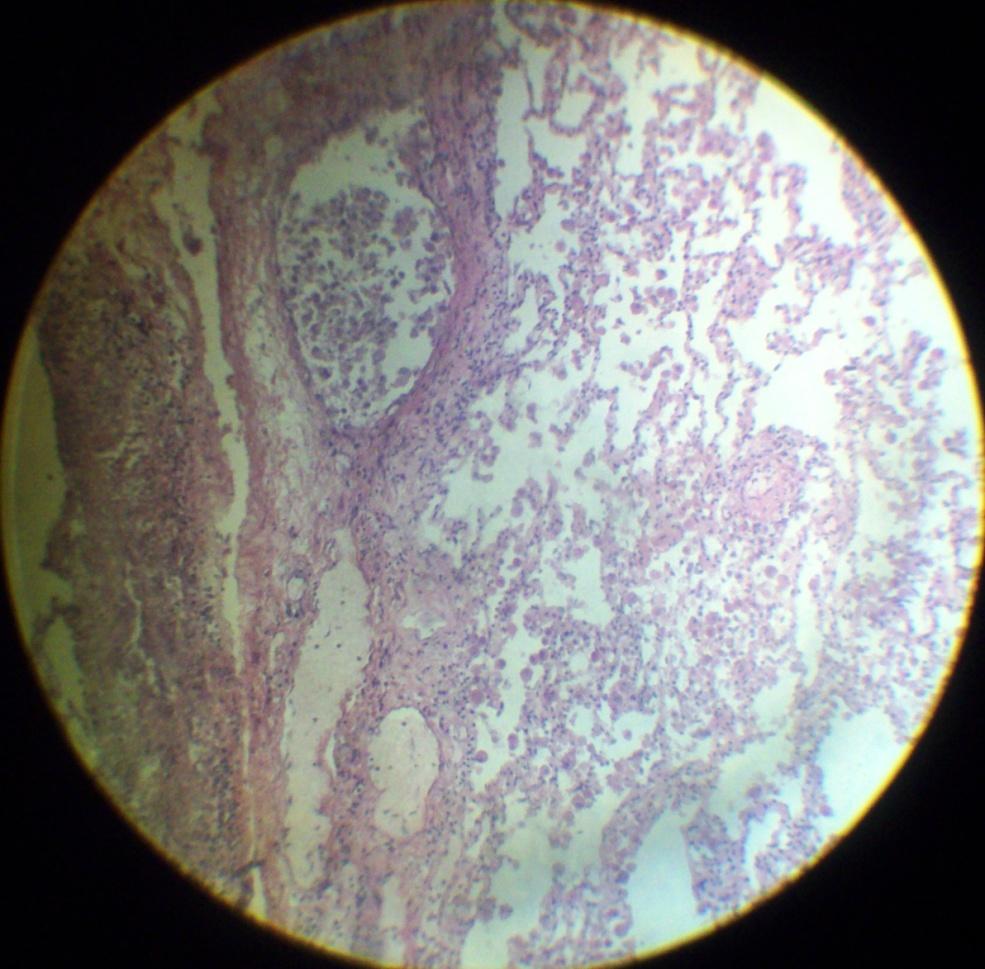 Гемосидероз стенки кисты яичника