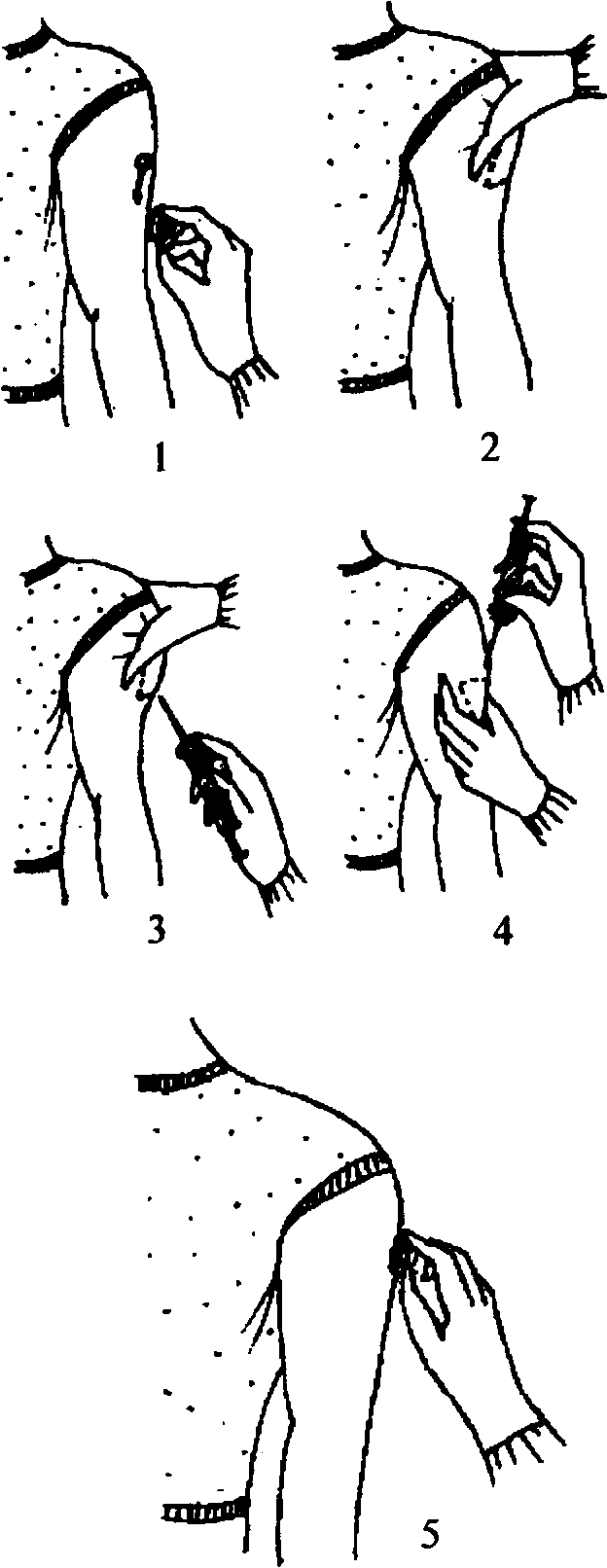 Этапы выполнения подкожной инъекции.