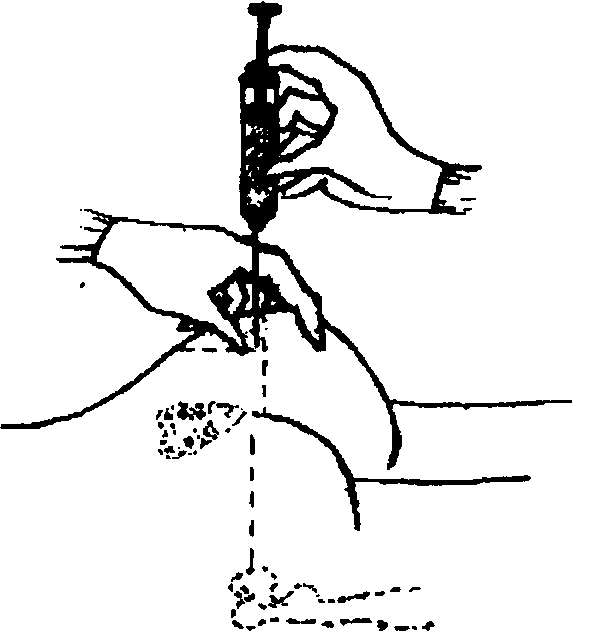 Схема уколов внутримышечно