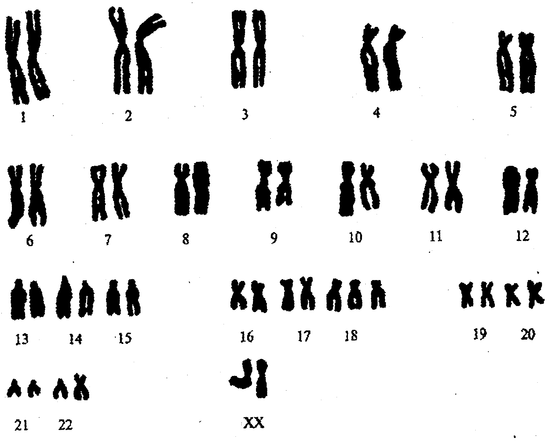 Нарушение 3 хромосомы