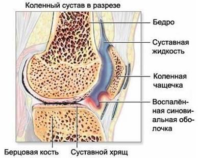 Патогенез деформирующего артроза коленного сустава