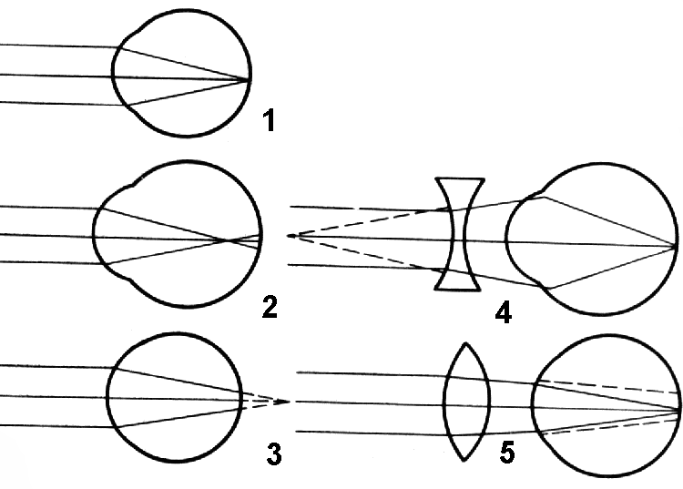 На каком из рисунков правильно показано исправление дальнозоркости