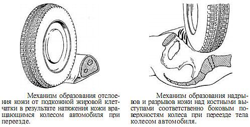 Диагностическим признаком переезда через тело колеса автомобильного транспортного средства является