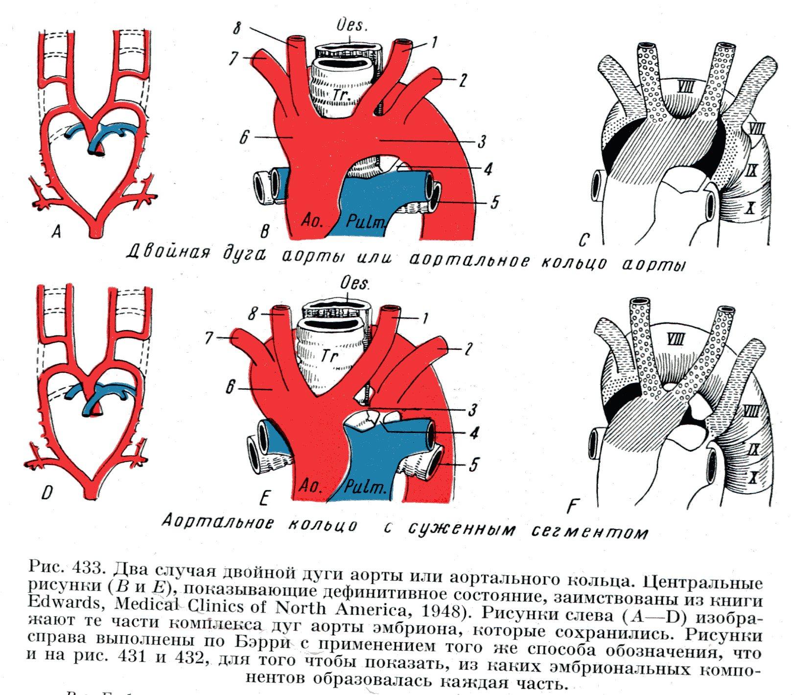 Аортальное сердце. Аномалии сосудов дуги аорты. Аномалии расположения дуги аорты. Двойная дуга аорты аортальное кольцо. Аортальное кольцо или персистирование обеих дуг аорты.