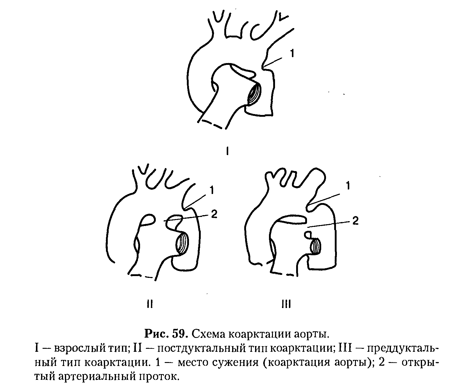 Коарктация аорты картинки