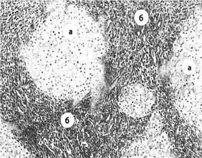 Макроскопическая картина цирроза печени