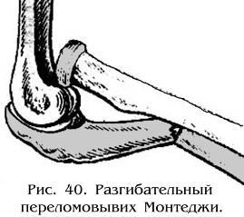 Диафизарные переломы предплечья Диафизарные переломы предплечья thumbnail