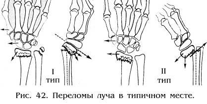 Диафизарные переломы предплечья